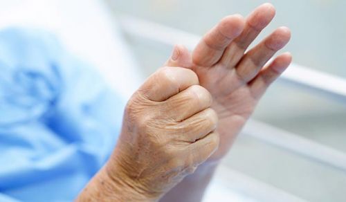 Rizartrose – Artrose na raiz do dedo polegar (da mão)